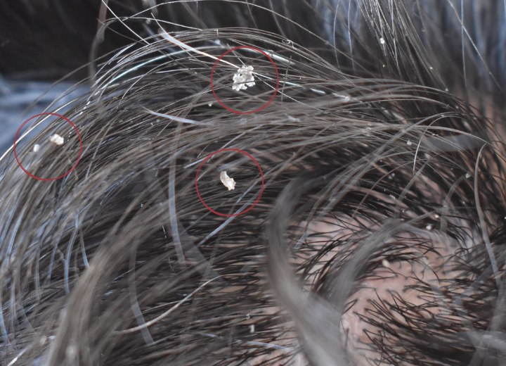 Haare mit Schuppen